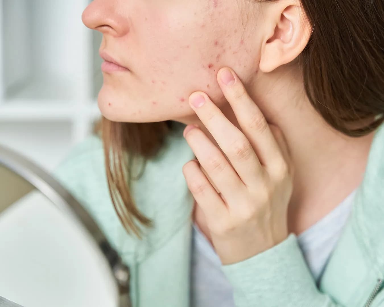 Determining the Right Ingredients for Acne Prone Skin